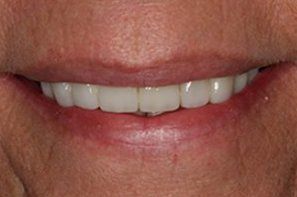 White repaired healthy front teeth