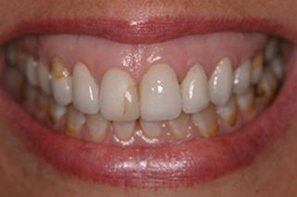 Woman with damaged front tooth