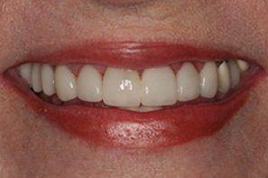 Womanw with fully repaired front teeth