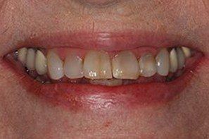 Woman with damged and discolored front teeth