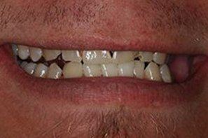 Man with crooked discolored teeth