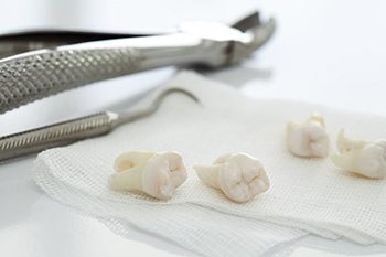extracted teeth lying on gauze pads 