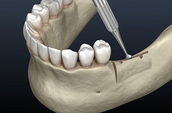 a 3D illustration of the ridge augmentation treatment