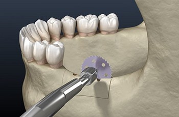 a 3D depiction of the ridge augmentation process