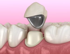 Rendering of a porcelain fused to metal dental crown