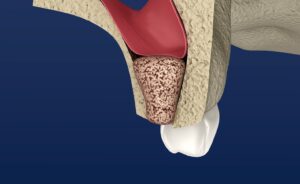 Bone grafting procedure for dental implants