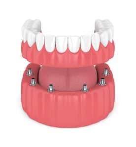 Model of implant-supported lower denture