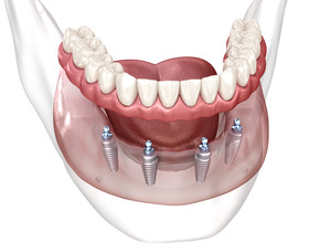 Illustration of All-on-4 for the lower arch